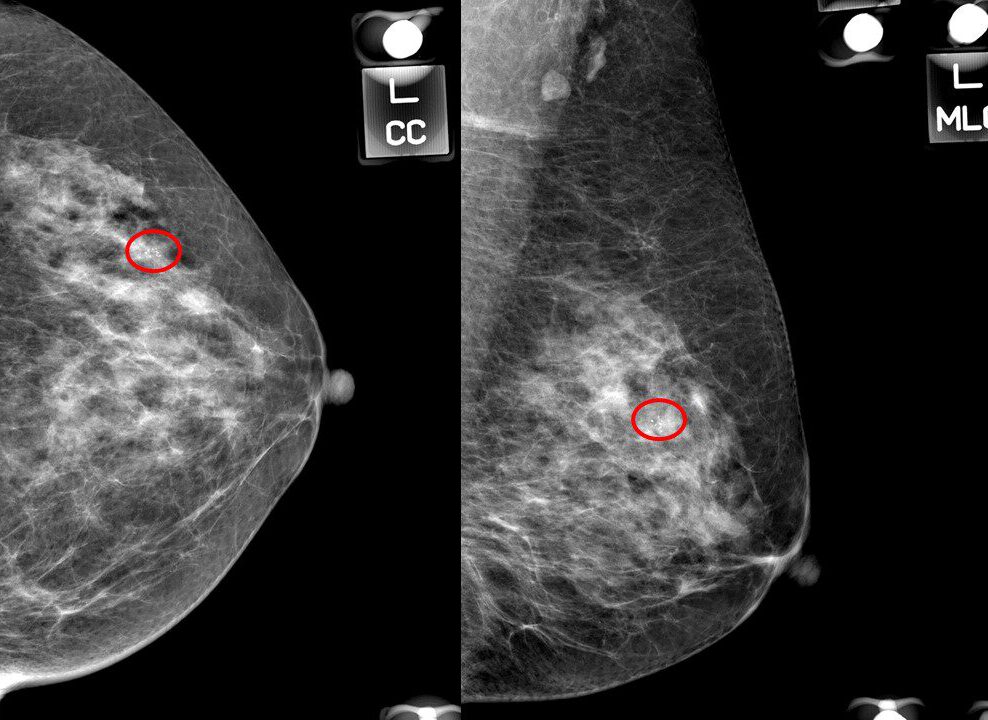 breast microcalcifications pic